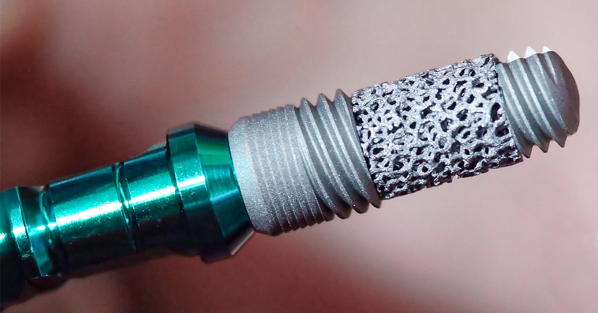 Zimmer Trabecular Metal tehnologia revoluţionară în stomatologia