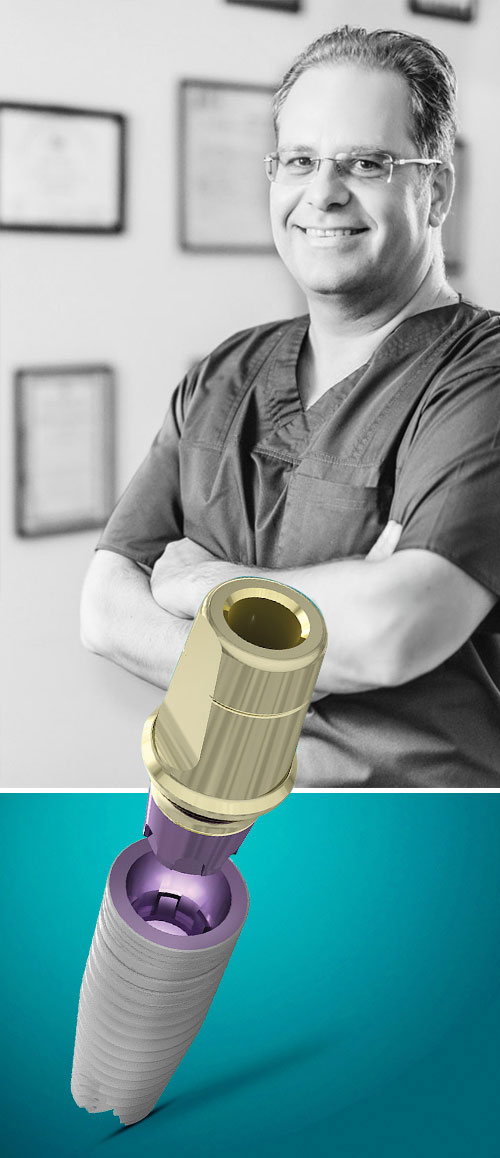 implant dentar implant dentar