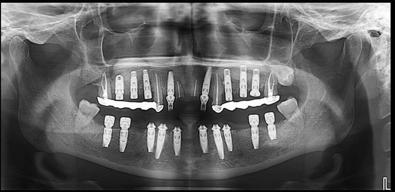 implant-2