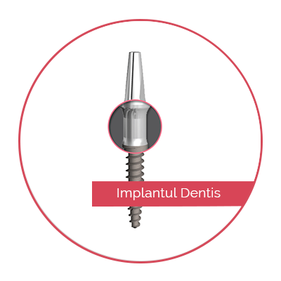 implantul-dentis