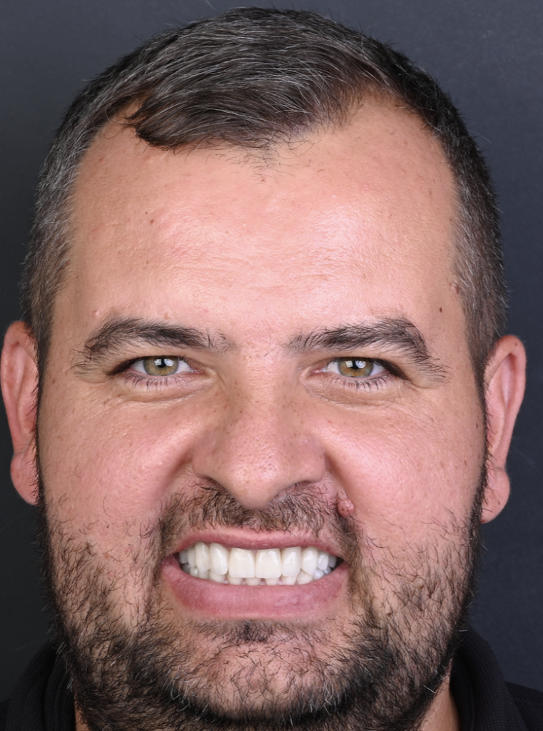 Andrei Reabilitare orală bimaxilară