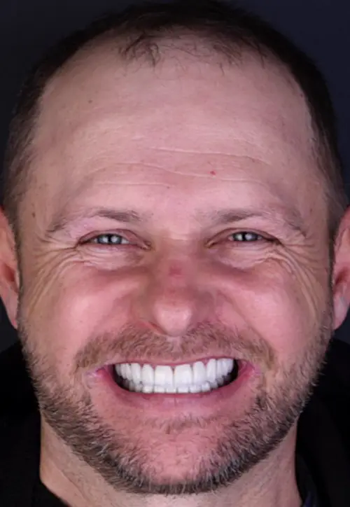 Pacient Reabilitare orală totală