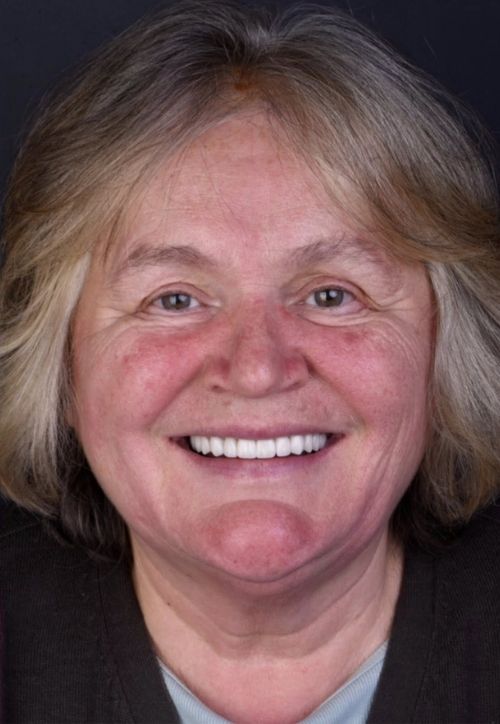 Pacient Reabilitare totală bimaxilară