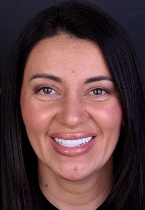 Simona Reabilitare orală bimaxilară complexă cu augmentări osoasă și implanturi