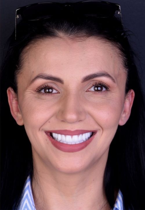 Pacient Reabilitare totală bimaxilară complexă cu reconstrucție osoasă și implanturi