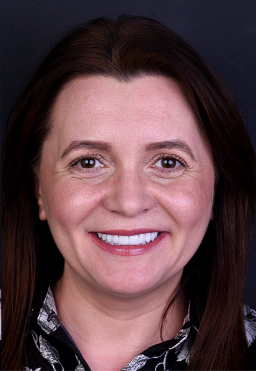 Pacient Reabilitare totală bimaxilară pe dinți și implanturi