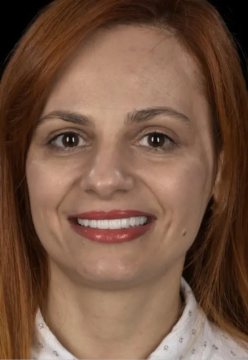 JanetaReabilitare estetică prin fațete și coroane din zirconiu